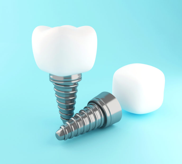 3d dental tooth implant 2021 08 29 10 14 31 utc