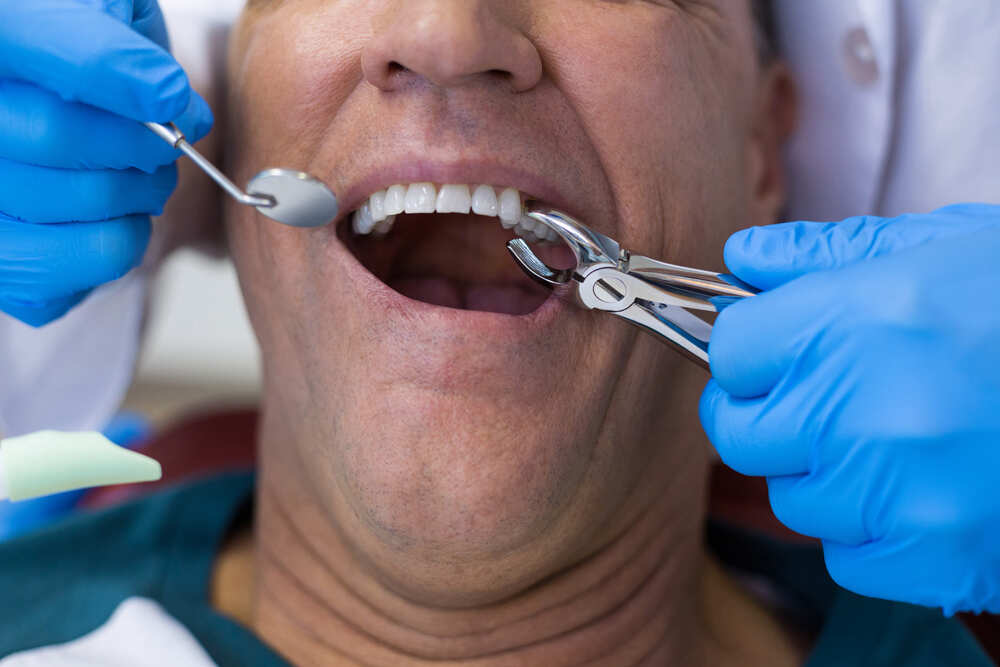 dentist using surgical pliers to remove a decaying 2021 08 28 16 45 02 utc