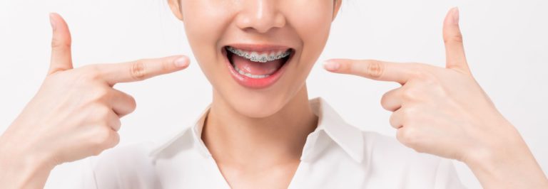 face of a young smiling asian woman with braces on 2021 09 01 18 14 37 utc 1