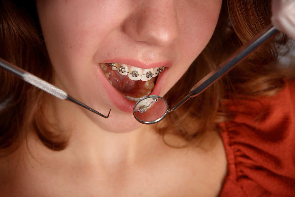 girl teeth braces and dentist tools 2022 08 01 03 07 39 utc