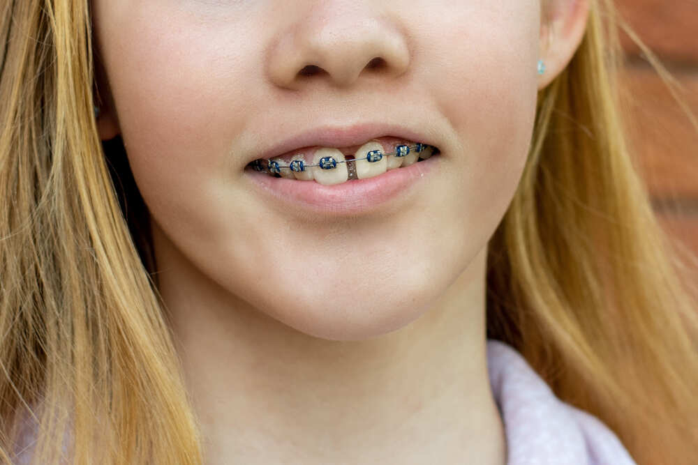 teenage girl wearing metal braces orthodontic den 2021 12 17 18 54 38 utc