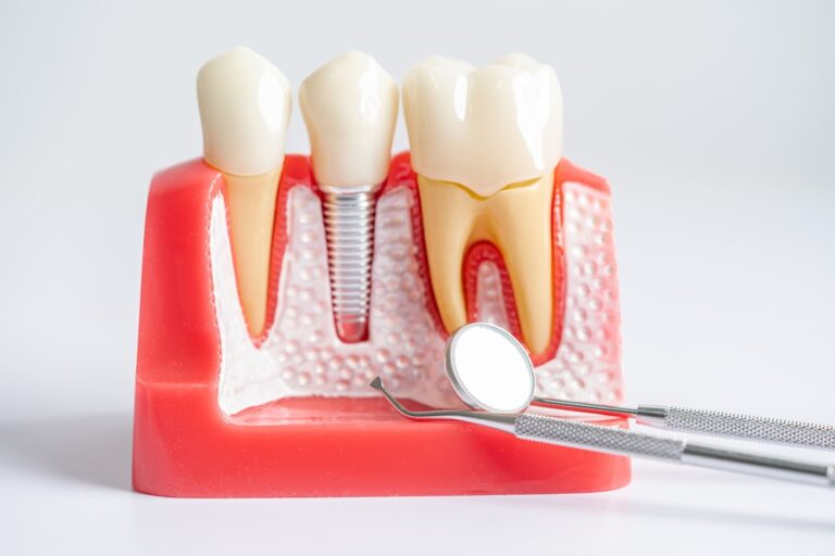 dental implant artificial tooth roots into jaw r 2023 12 22 17 08 37 utc 1