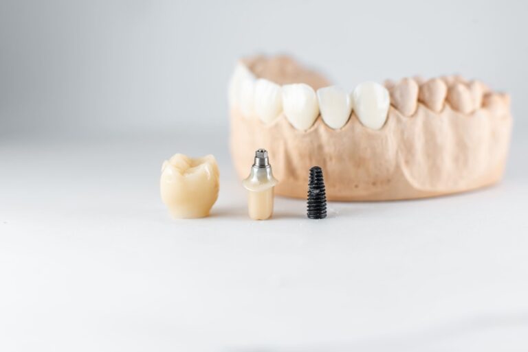 model of artificial jaw and dental implant 2023 11 27 05 19 37 utc 2 1