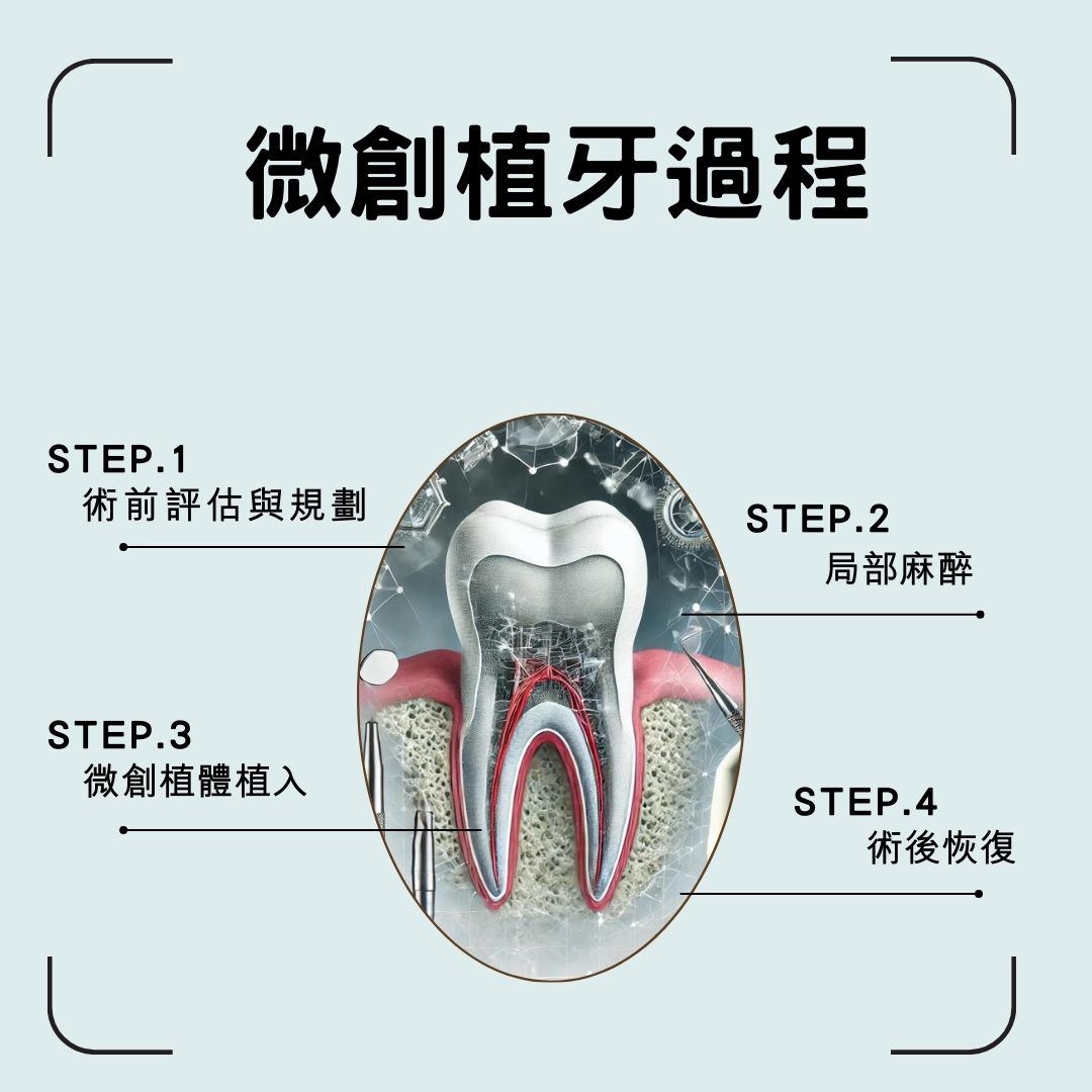 說明微創植牙的過程