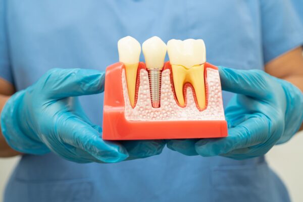 dental-implant-artificial-tooth-roots-into-jaw-r-2024-04-30-02-28-10-utc (1)